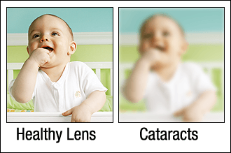 Your vision with cataracts 