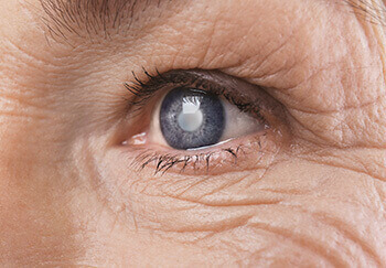 closeup of cataract
