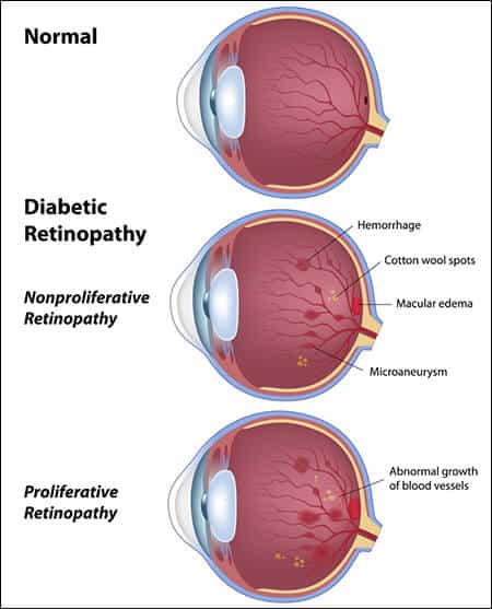 Diabetic Eye Care