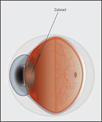 Cataract Anatomy 