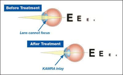 Kamra Procedure 